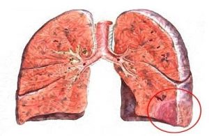 инфаркт легких