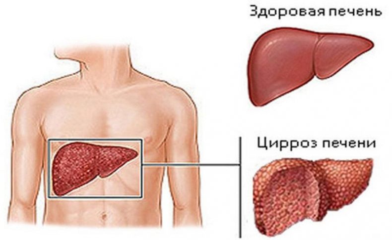 цирроз