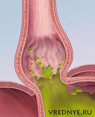 отрыжка и изжога отрыжка и изжога