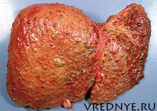 Печень алкоголика: влияние, болезни, лечение