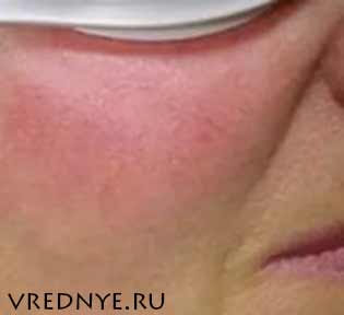 Почему от алкоголя краснеет лицо и что с этим делать