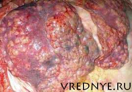 признаки цирроза печени у заядлых алкоголиков признаки цирроза печени у заядлых алкоголиков