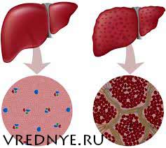 признаки цирроза печени у заядлых алкоголиков признаки цирроза печени у заядлых алкоголиков