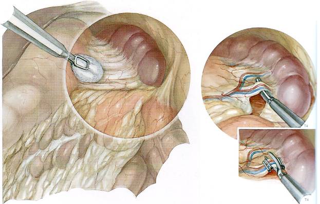 спленэктомия
