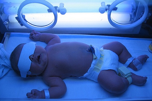 светолечение желтухи у новорожденных