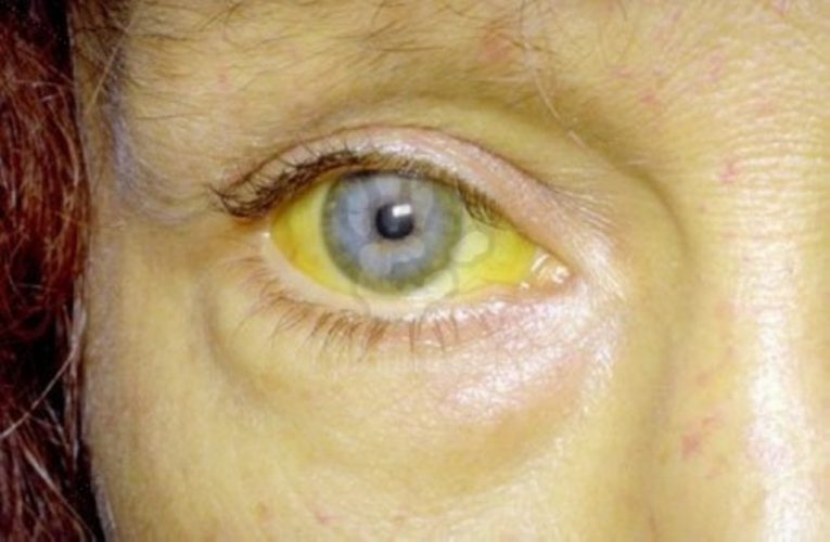 Механическая желтуха