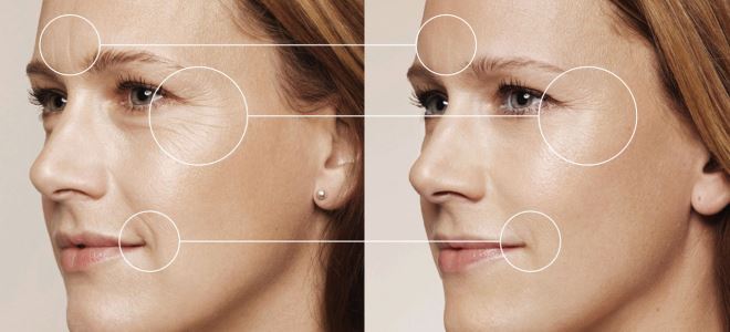 биоревитализация фото до и после