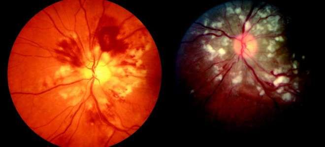 Ангиопатия сосудов сетчатки что это такое Ангиопатия сосудов сетчатки что это такое
