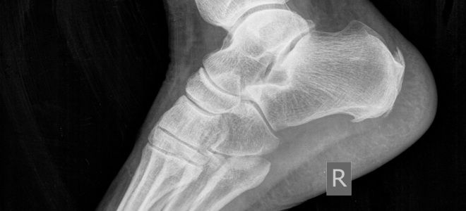 фото1 борьба с пяточной шпорой