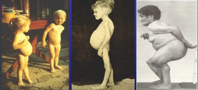 целиакия симптомы целиакия симптомы