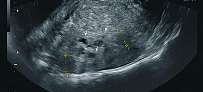 что такое эндометриоз что такое эндометриоз