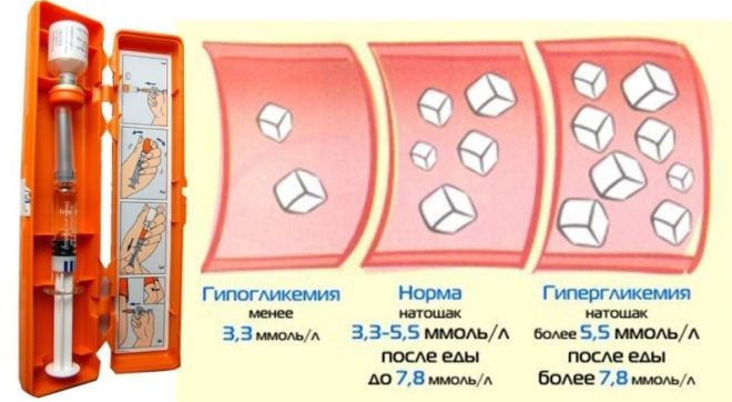 что такое гипогликемия что такое гипогликемия