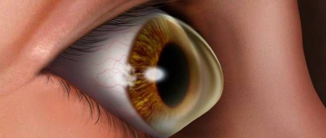 что такое кератоконус что такое кератоконус