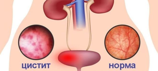 цистит лечение препараты цистит лечение препараты