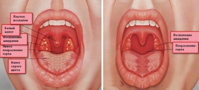 герпетическая ангина у детей герпетическая ангина у детей