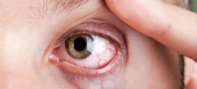 Хронический бактериальный конъюнктивит Хронический бактериальный конъюнктивит