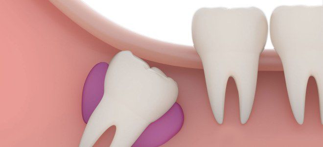 Как растут зубы мудрости Как растут зубы мудрости