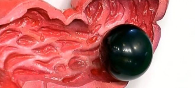 кал с кровью кал с кровью