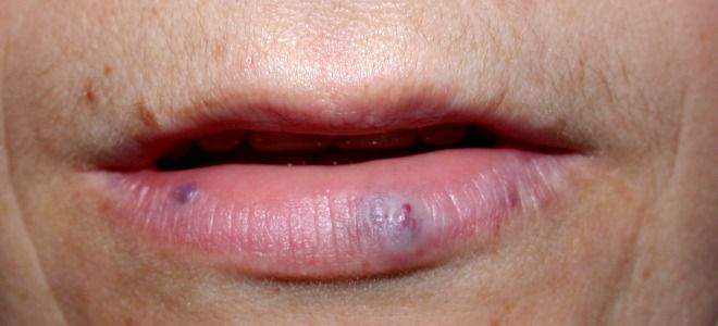 Кавернозная гемангиома Кавернозная гемангиома