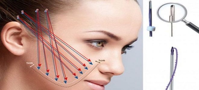 фото1 мезонити aptos