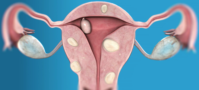 множественная миома матки множественная миома матки