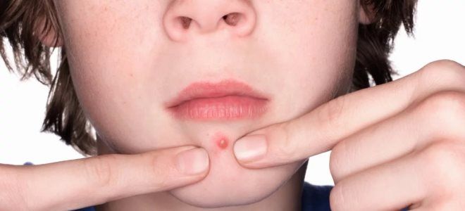 подростковые прыщи у мальчиков причины подростковые прыщи у мальчиков причины