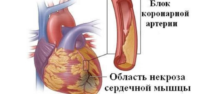 причины инфаркта миокарда причины инфаркта миокарда