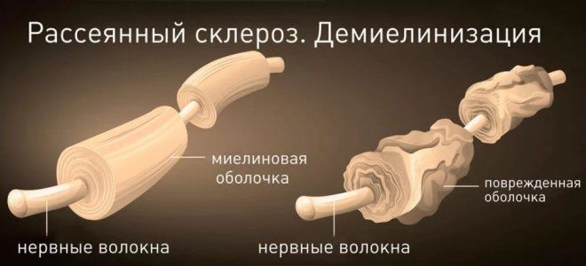 причины рассеянного склероза у женщин причины рассеянного склероза у женщин