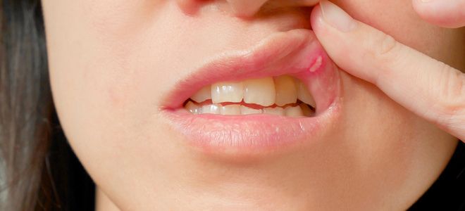 причины язвенного стоматита причины язвенного стоматита