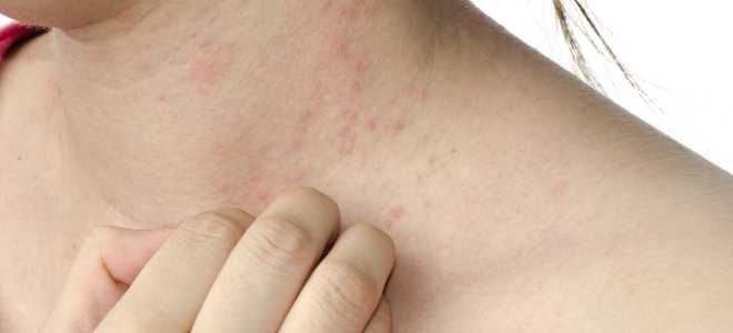 сывороточная болезнь симптомы сывороточная болезнь симптомы