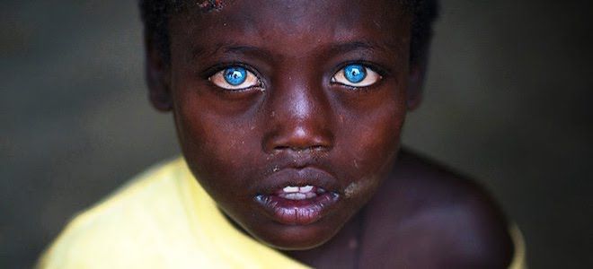 тип мутации при синдроме ваарденбурга тип мутации при синдроме ваарденбурга