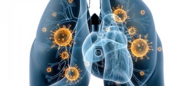 вирусное воспаление легких вирусное воспаление легких