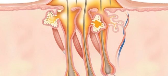 фото1 внутренний чирей