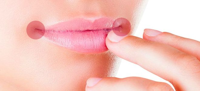 заеды в уголках рта быстрое лечение заеды в уголках рта быстрое лечение