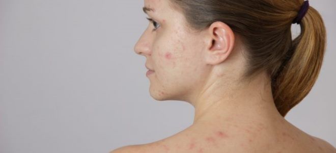 фото2 ацикловир при