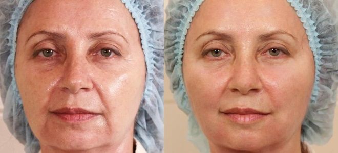 что дает rf лифтинг что дает rf лифтинг