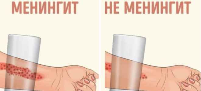 диагностика при менингите диагностика при менингите