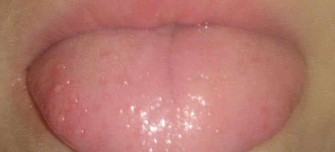 герпетическая ангина симптомы герпетическая ангина симптомы