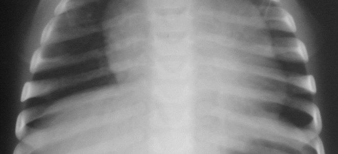 киста тимуса у детей киста тимуса у детей