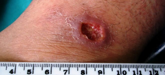 кожный лейшманиоз симптомы кожный лейшманиоз симптомы