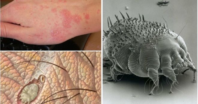 признаки чесотки признаки чесотки