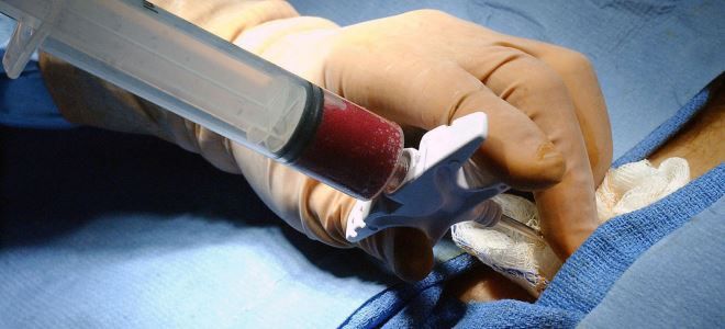 пункция костного мозга пункция костного мозга