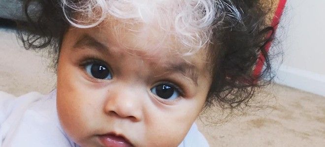 синдром ваарденбурга диагностика синдром ваарденбурга диагностика