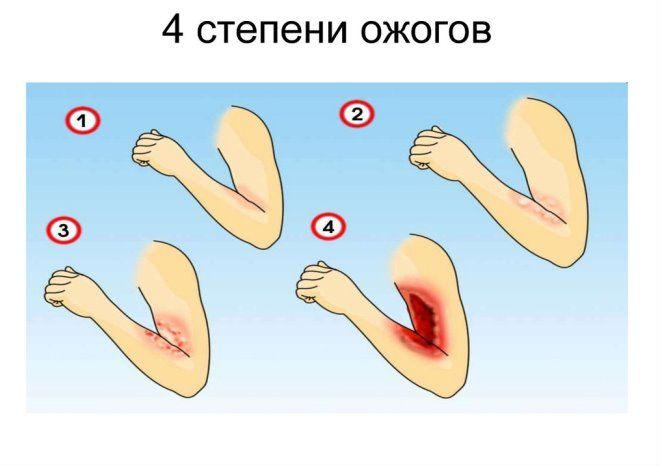 степени ожогов степени ожогов