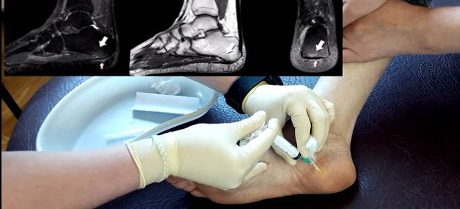 фото2 удаление пяточной шпоры