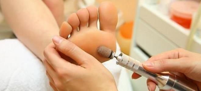 удаление стержневой мозоли удаление стержневой мозоли