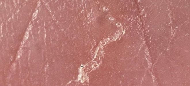 чесотка симптомы первые признаки чесотка симптомы первые признаки