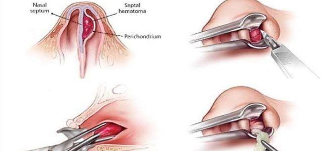 фото3 как удалить чирей