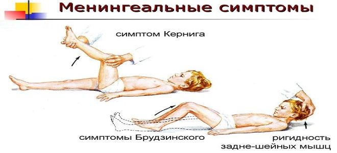 синдром кернига синдром кернига