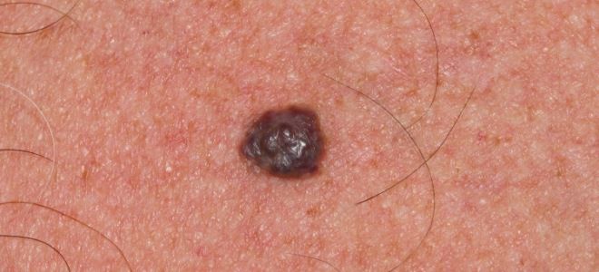 Смешанная гемангиома Смешанная гемангиома